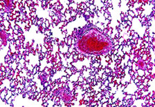 Microscopic view of tuberculosis-infected lung. Image courtesy of A.J. Cann at www.flickr.com/photos/ajc1.